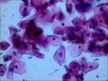 25岁，宫颈TCT，2度糜烂。外阴有赘生物。LSIL？疑HPV感染！图2