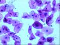 25岁，宫颈TCT，2度糜烂。外阴有赘生物。LSIL？疑HPV感染！图12