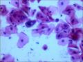 25岁，宫颈TCT，2度糜烂。外阴有赘生物。LSIL？疑HPV感染！图6