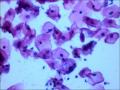 25岁，宫颈TCT，2度糜烂。外阴有赘生物。LSIL？疑HPV感染！图7