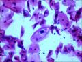 25岁，宫颈TCT，2度糜烂。外阴有赘生物。LSIL？疑HPV感染！图4