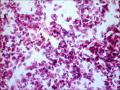 25岁，宫颈TCT，2度糜烂。外阴有赘生物。LSIL？疑HPV感染！图5