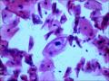 25岁，宫颈TCT，2度糜烂。外阴有赘生物。LSIL？疑HPV感染！图8