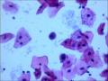 25岁，宫颈TCT，2度糜烂。外阴有赘生物。LSIL？疑HPV感染！图11