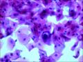 25岁，宫颈TCT，2度糜烂。外阴有赘生物。LSIL？疑HPV感染！图3