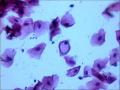 25岁，宫颈TCT，2度糜烂。外阴有赘生物。LSIL？疑HPV感染！图9