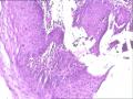 女，46岁，轻度糜烂图3