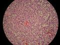 卵巢和腹腔多发性肿瘤（PT11-15266）图8