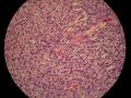 卵巢和腹腔多发性肿瘤（PT11-15266）图16