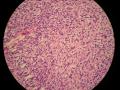 卵巢和腹腔多发性肿瘤（PT11-15266）图17