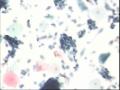 TCT,33岁，宫颈糜烂，充血。图9
