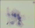 请教：ASC-US？ASC-H？还是其他呢？图10