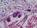 Lung lesion图4