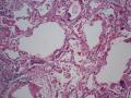 Lung lesion图1
