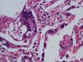 Lung lesion图3