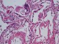 Lung lesion图2