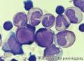 Bone marrow smear - 1图2