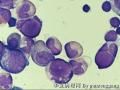 Bone marrow smear - 1图1