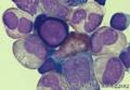 Bone marrow smear - 1图5