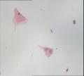 TCT 患者34岁  宫颈中毒糜烂  宫颈肥大图11