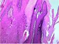 右大腿肿物-补充低倍照片图12