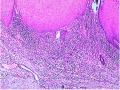 右大腿肿物-补充低倍照片图10