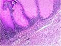 右大腿肿物-补充低倍照片图29