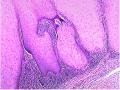 右大腿肿物-补充低倍照片图47