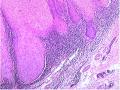 右大腿肿物-补充低倍照片图52