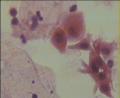 曾做个锥切术，病理报告CIN-2，现在复查图16