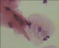 曾做个锥切术，病理报告CIN-2，现在复查图10