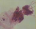 曾做个锥切术，病理报告CIN-2，现在复查图6