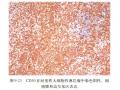 淋巴瘤常用标记物详解-T、B以外的细胞图8