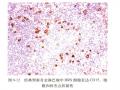 淋巴瘤常用标记物详解-T、B以外的细胞图7