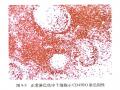 淋巴瘤常用标记物详解-T、B以外的细胞图15