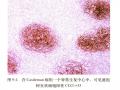 淋巴瘤常用标记物详解-T、B以外的细胞图5