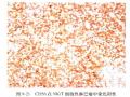 淋巴瘤常用标记物详解-T、B以外的细胞图1