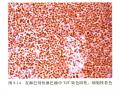 淋巴瘤常用标记物详解-T、B以外的细胞图3