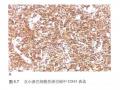 淋巴瘤常用标记物详解-T、B以外的细胞图14
