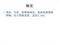 肾脏肿块，男性，72岁图1