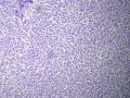 鼻后孔肿物,新加免疫组化图2