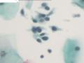 20岁女性的液基片图5