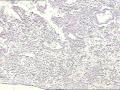 宫颈管活检，间质咋这样？图2