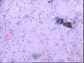 TCT+活检组织对照病例一32岁 查体    上传组织对照片图5