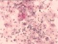 TCT报告：报了ASC-H，现送活检，请大家帮忙看看。图4