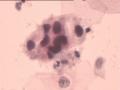 TCT报告：报了ASC-H，现送活检，请大家帮忙看看。图11