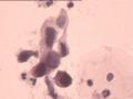 TCT报告：报了ASC-H，现送活检，请大家帮忙看看。图14