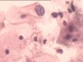 TCT报告：报了ASC-H，现送活检，请大家帮忙看看。图6