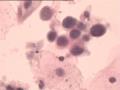 TCT报告：报了ASC-H，现送活检，请大家帮忙看看。图7