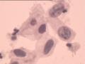 TCT报告：报了ASC-H，现送活检，请大家帮忙看看。图16